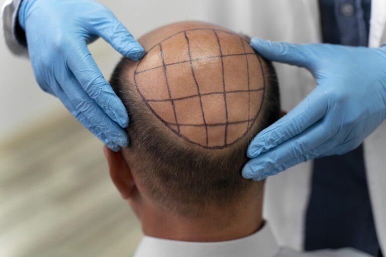 combien de temps dure une greffe de cheveux